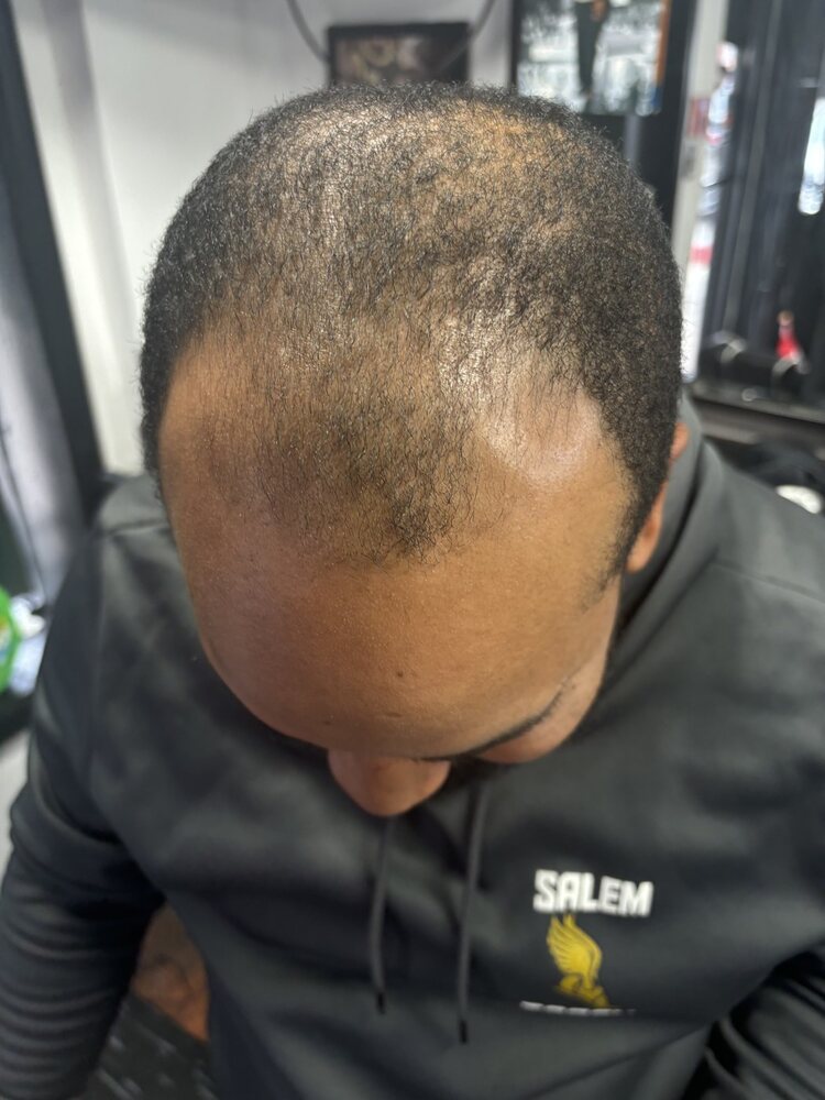 Trial participant scalp before consistent use