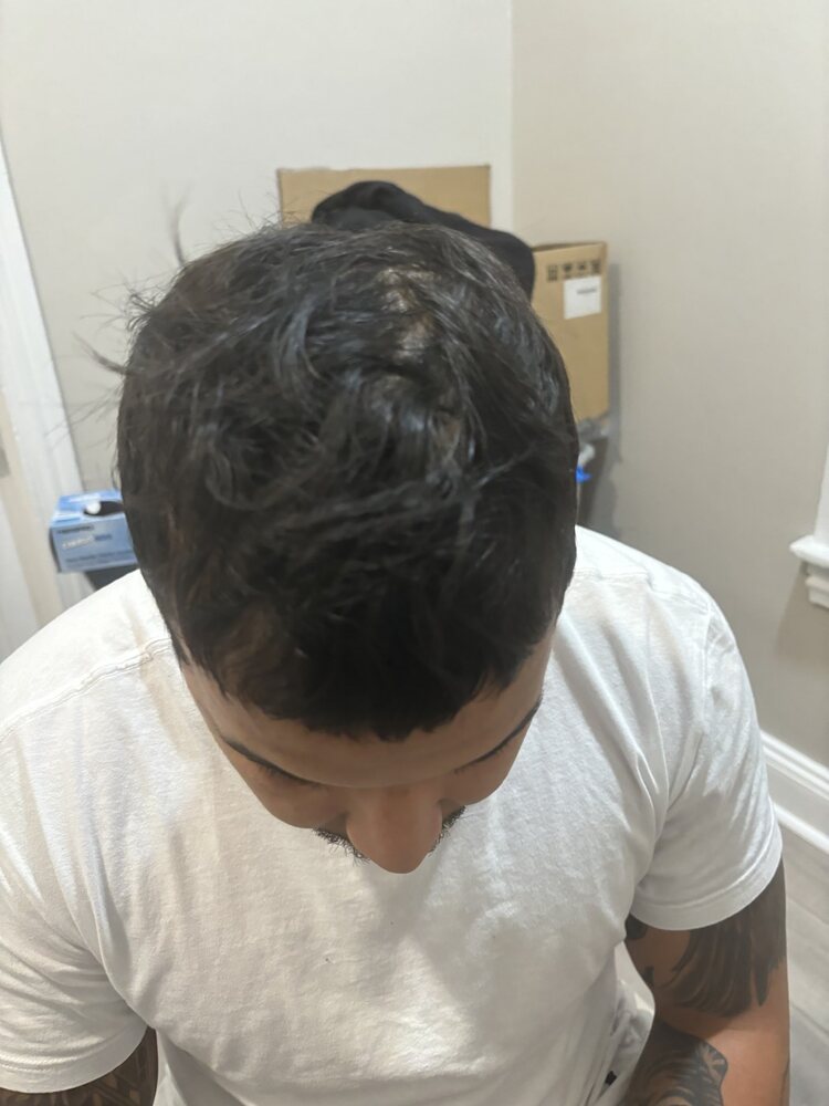 Second trial participant after a consistent scalp routine