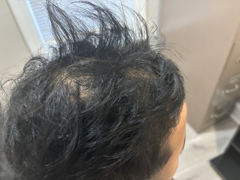 Second trial participant scalp before consistent use